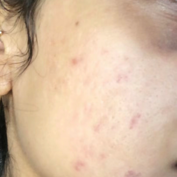 Skincare before and after: close-up of a cheek with acne, then clearer, calmer skin on her second bottle of SHIFAH serum