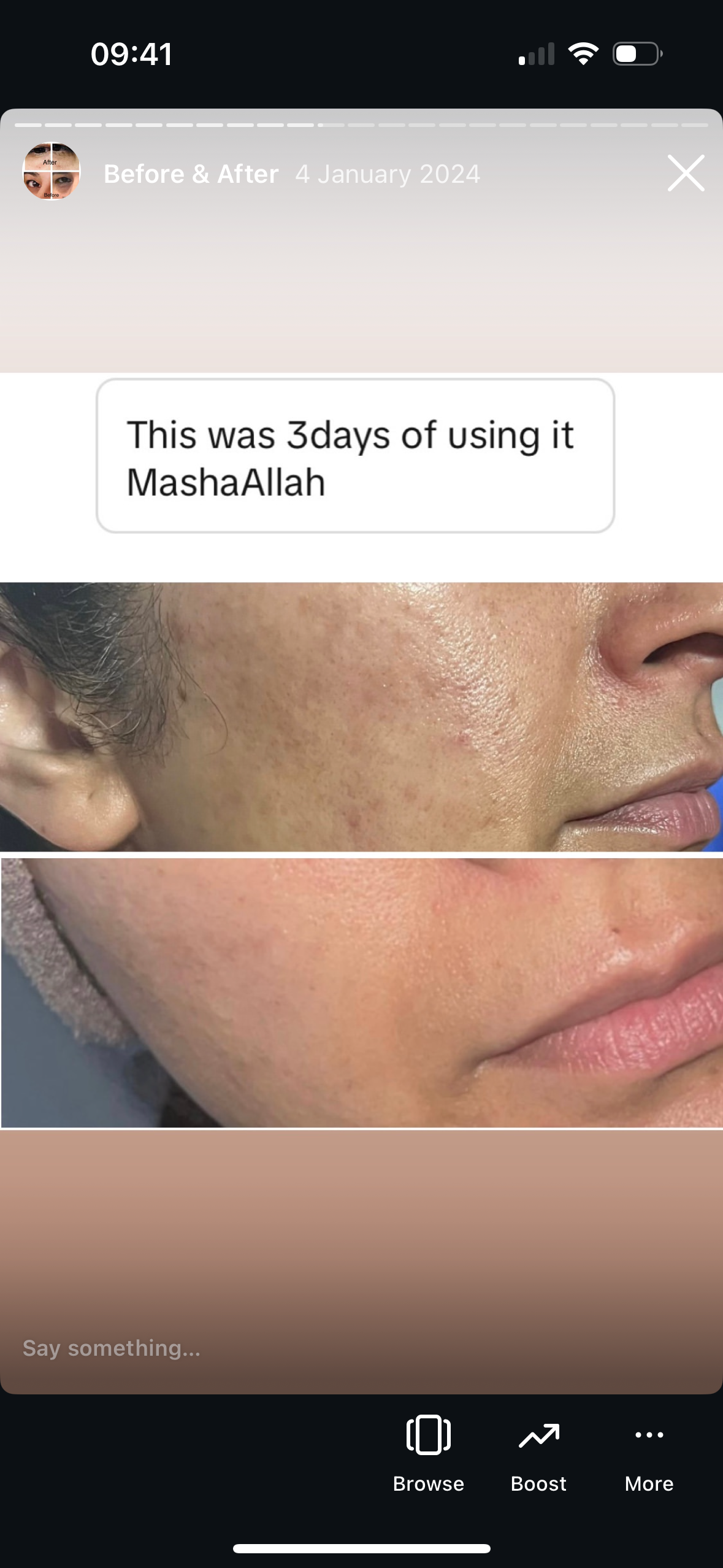 Skincare before and after: close-up of rough, uneven skin texture, then smoother skin after 3 days