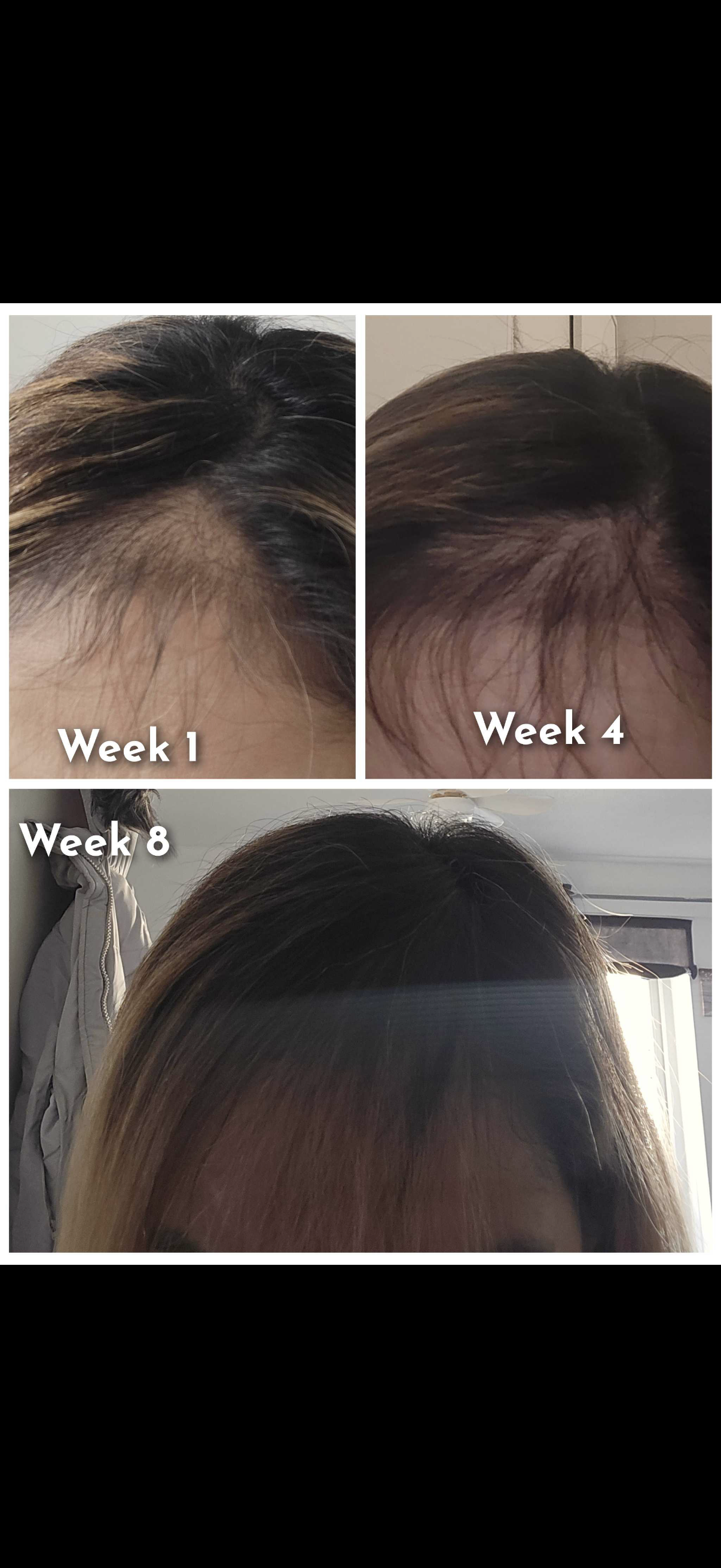 Haircare before and after: thinning hairline at week 1, then fuller-looking hair at week 4 of SHIFAH rice water care