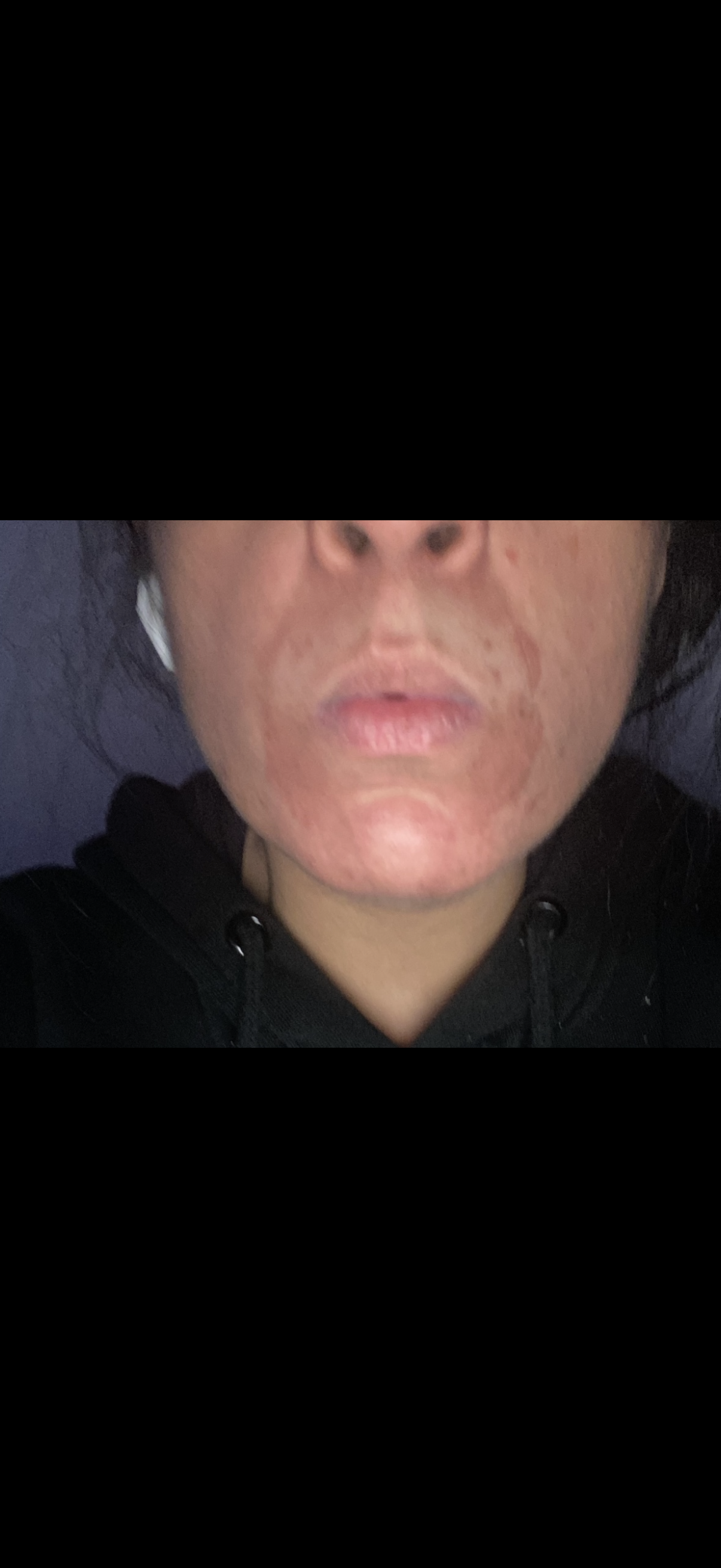 Before and after: SHIFAH customer with red burns around the mouth after a Hydrafacial, then calm, healed skin