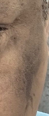 Skincare before and after: Zara's cheek after 4 weeks of her SHIFAH routine