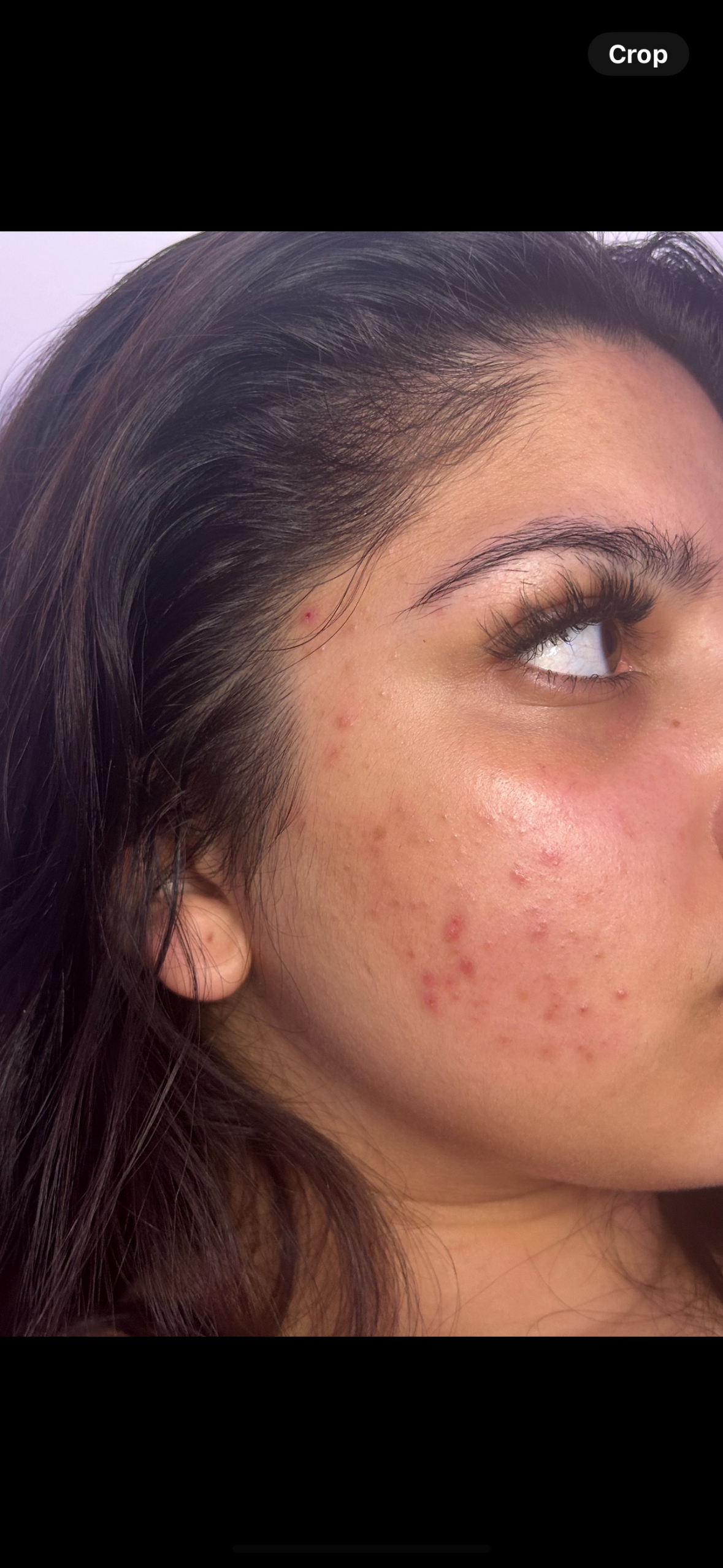 Skincare before and after: close-up of a young girl’s cheek with acne and red marks, then clear, calm skin