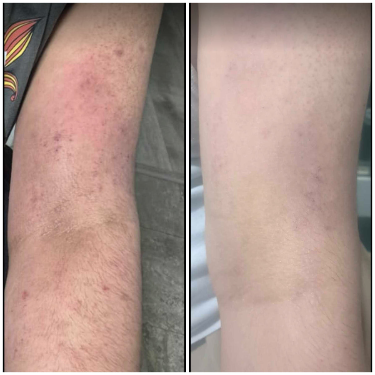 Body skincare before and after: real SHIFAH customer arm skin result