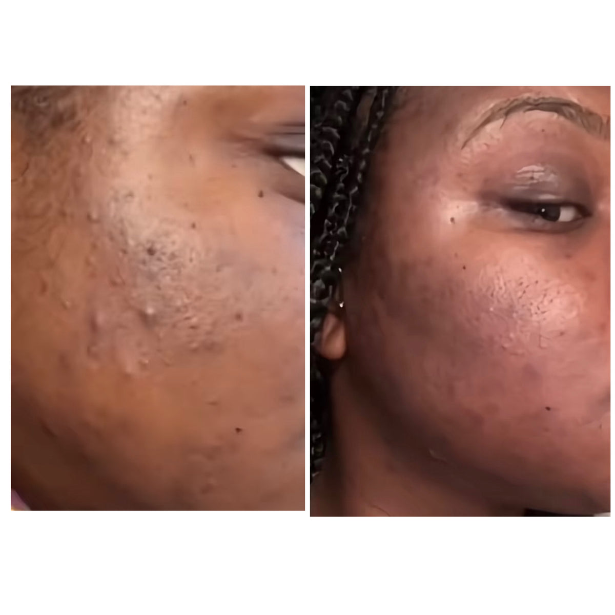 Skincare results: real SHIFAH customer cheek with smoother texture after