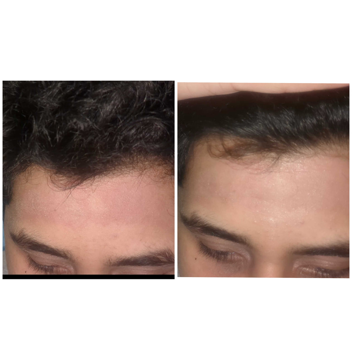 Forehead skincare before and after: real SHIFAH customer result