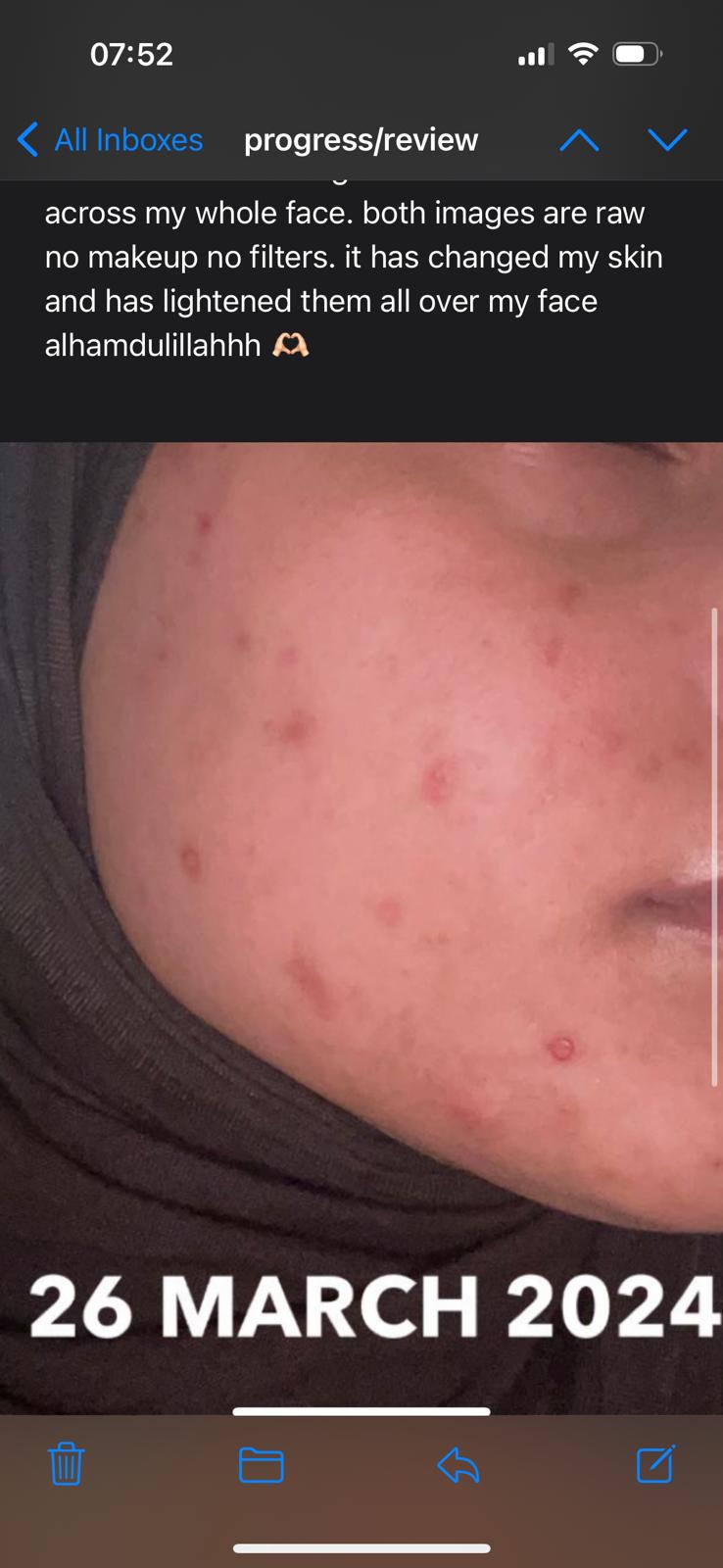Skincare before and after: close-up of a cheek with dark spots, then lighter, more even skin with no makeup or filters